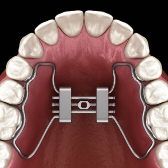 A palatal expander, a dental device used to correct malocclusions such as crossbites and crowding by widening the upper jaw.
